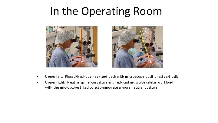 In the Operating Room • • Upper left: Flexed/kyphotic neck and back with microscope