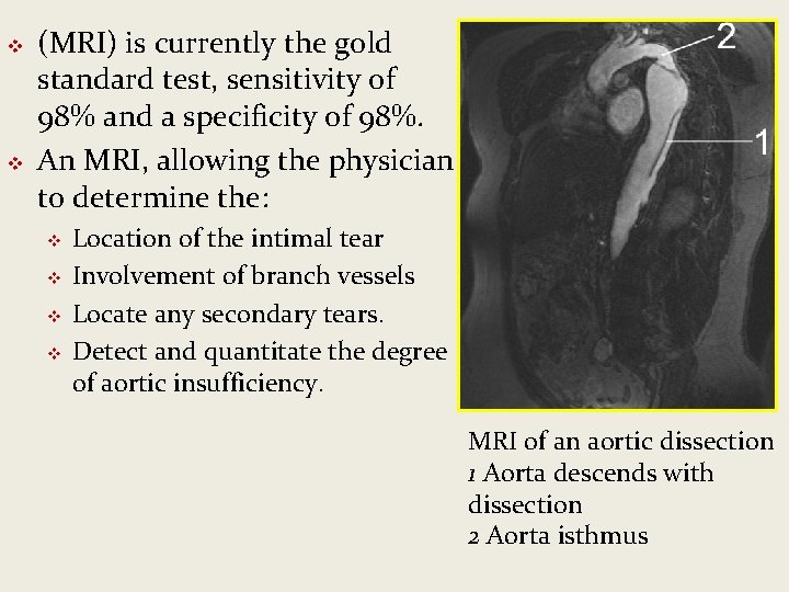 v v (MRI) is currently the gold standard test, sensitivity of 98% and a v v (MRI) is currently the gold standard test, sensitivity of 98% and a
