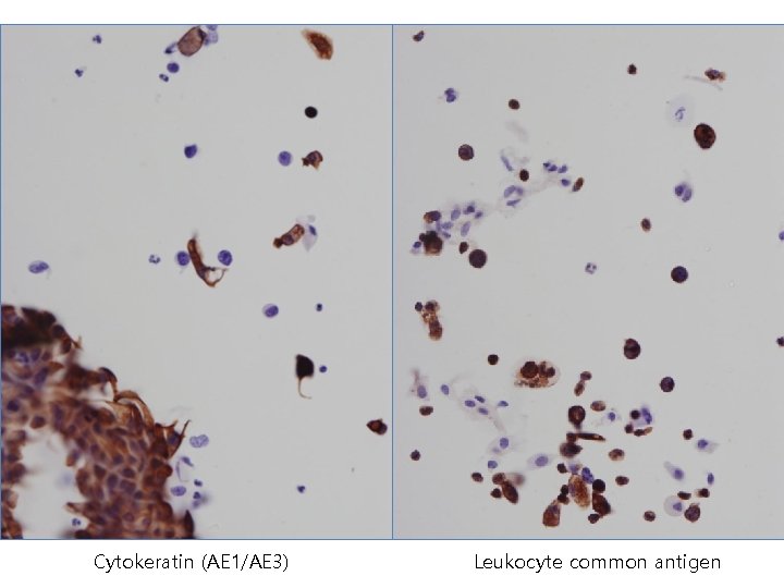 Cytokeratin (AE 1/AE 3) Leukocyte common antigen 