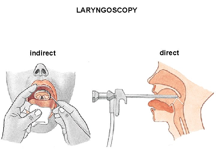 LARYNGOSCOPY indirect 