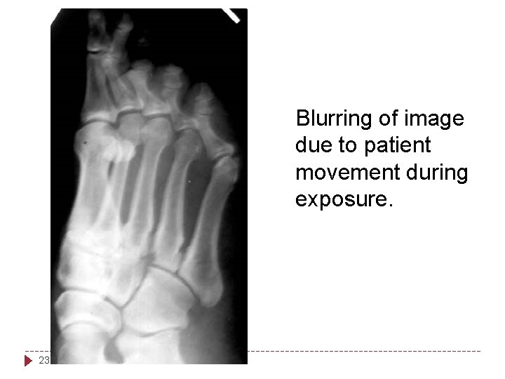 Blurring of image due to patient movement during exposure. 23 