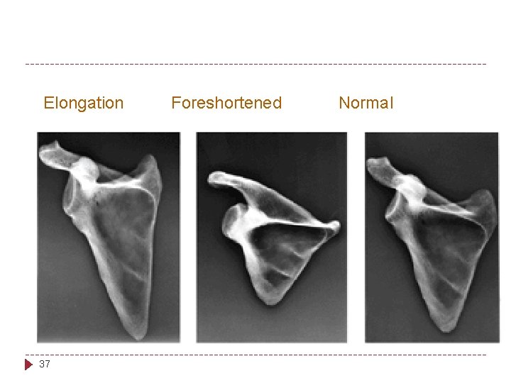 Elongation 37 Foreshortened Normal 