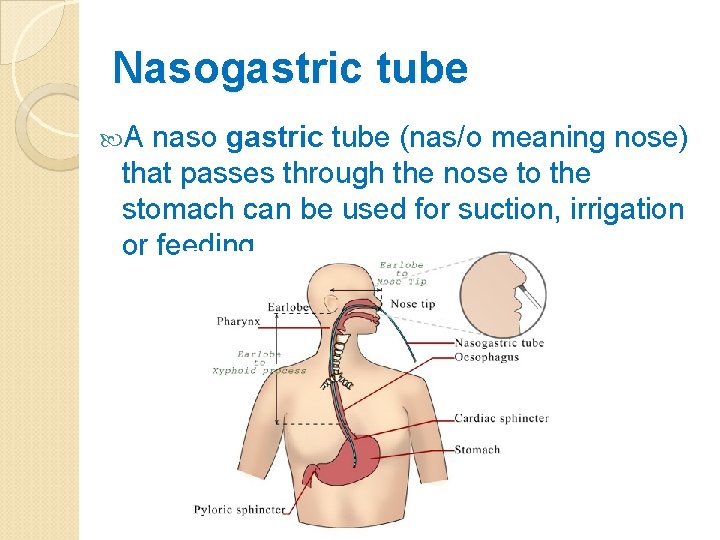 Nasogastric tube A naso gastric tube (nas/o meaning nose) that passes through the nose