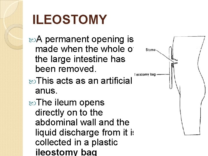 ILEOSTOMY A permanent opening is made when the whole of the large intestine has