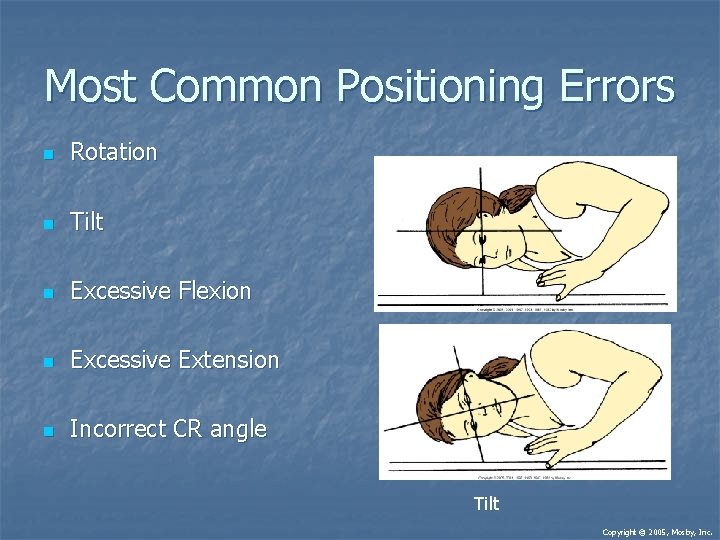 Most Common Positioning Errors n Rotation n Tilt n Excessive Flexion n Excessive Extension Most Common Positioning Errors n Rotation n Tilt n Excessive Flexion n Excessive Extension