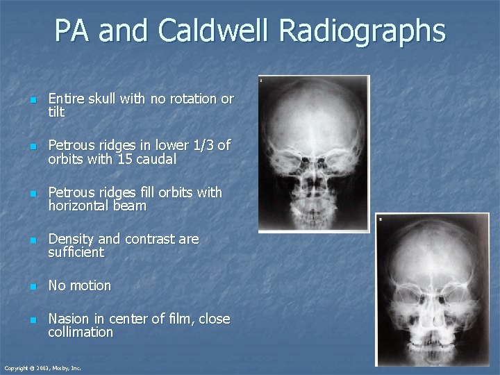 PA and Caldwell Radiographs n Entire skull with no rotation or tilt n Petrous PA and Caldwell Radiographs n Entire skull with no rotation or tilt n Petrous