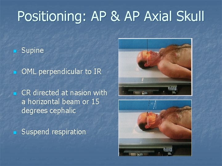 Positioning: AP & AP Axial Skull n Supine n OML perpendicular to IR n Positioning: AP & AP Axial Skull n Supine n OML perpendicular to IR n