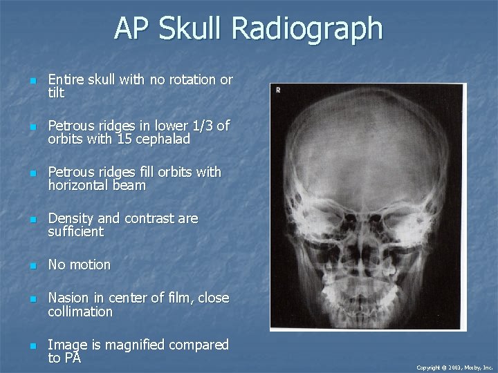 AP Skull Radiograph n Entire skull with no rotation or tilt n Petrous ridges AP Skull Radiograph n Entire skull with no rotation or tilt n Petrous ridges