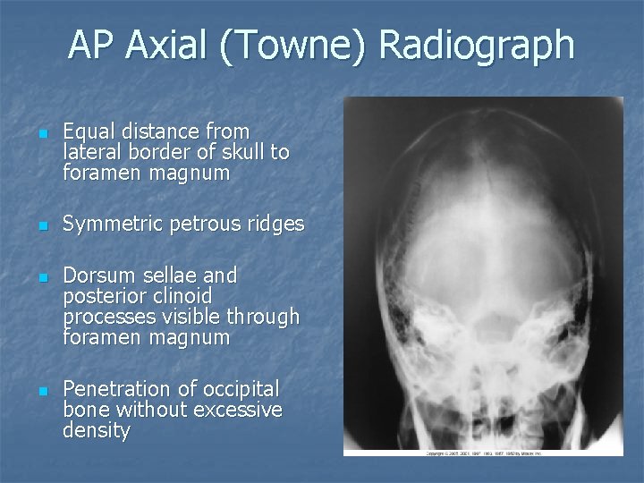 AP Axial (Towne) Radiograph n n Equal distance from lateral border of skull to AP Axial (Towne) Radiograph n n Equal distance from lateral border of skull to