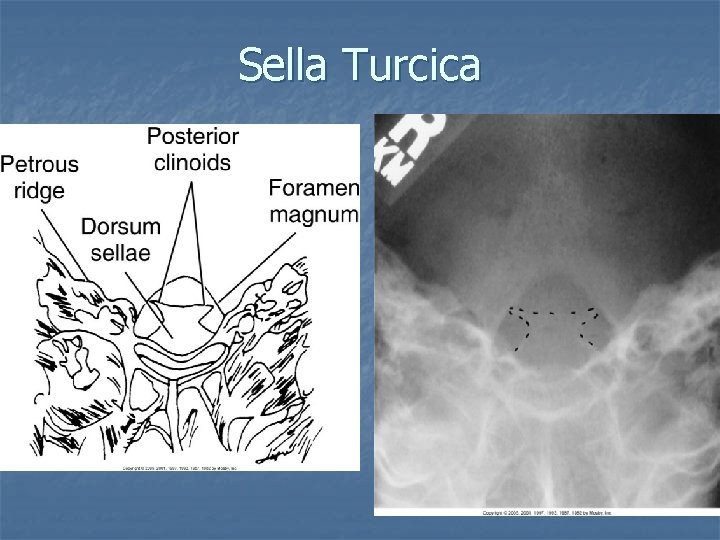 Sella Turcica Sella Turcica