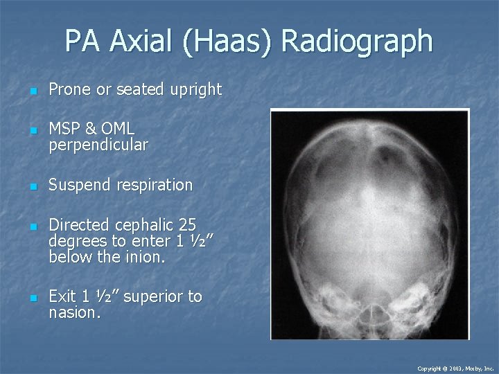 PA Axial (Haas) Radiograph n Prone or seated upright n MSP & OML perpendicular PA Axial (Haas) Radiograph n Prone or seated upright n MSP & OML perpendicular