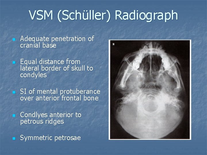 VSM (Schüller) Radiograph n n Adequate penetration of cranial base Equal distance from lateral VSM (Schüller) Radiograph n n Adequate penetration of cranial base Equal distance from lateral
