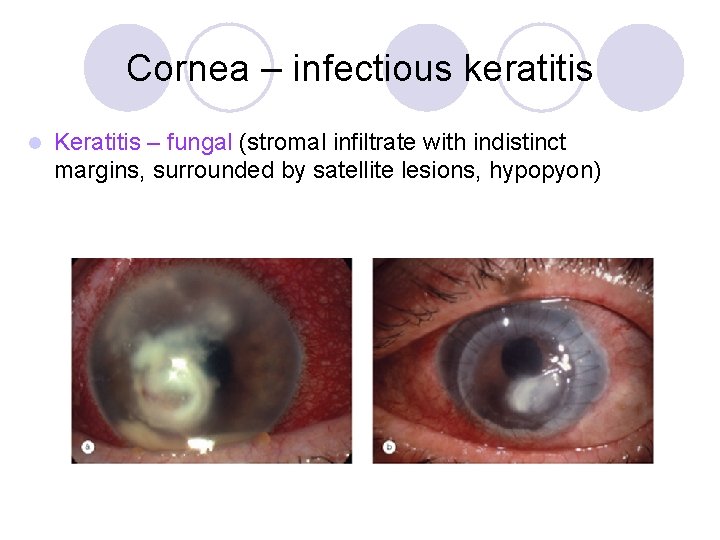 Cornea – infectious keratitis l Keratitis – fungal (stromal infiltrate with indistinct margins, surrounded