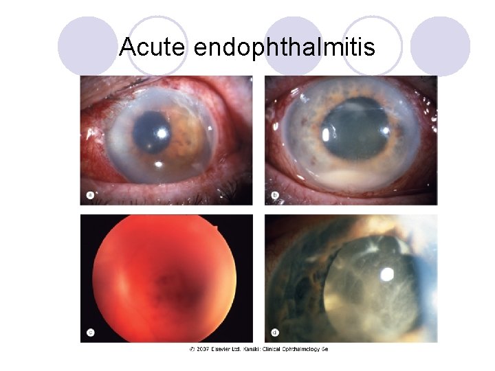 Acute endophthalmitis 