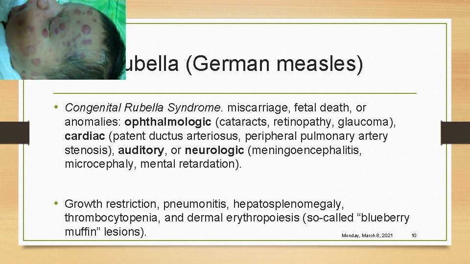 Rubella (German measles) • Congenital Rubella Syndrome. miscarriage, fetal death, or anomalies: ophthalmologic (cataracts,
