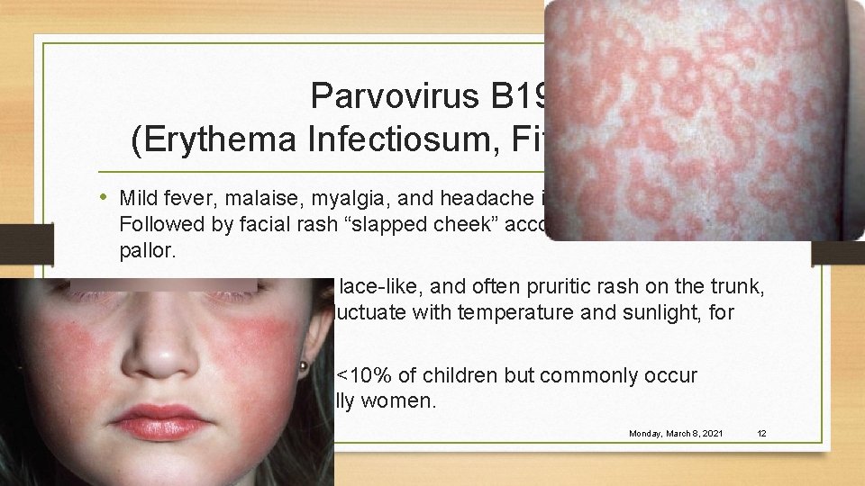 Parvovirus B 19 (Erythema Infectiosum, Fifth Disease) • Mild fever, malaise, myalgia, and headache