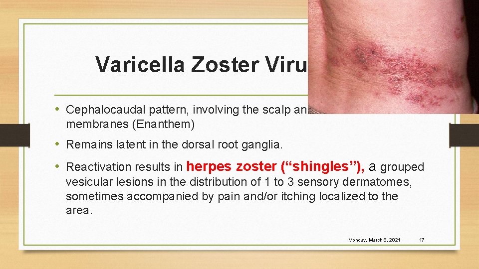 Varicella Zoster Virus (VZV) • Cephalocaudal pattern, involving the scalp and mucous membranes (Enanthem)