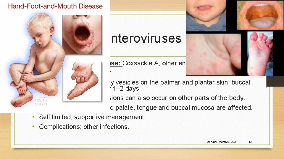 Enteroviruses 1 - Hand-foot-mouth disease: Coxsackie A, other enteroviruses • Fever, lymphadenopathy • 2–