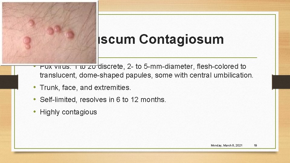 Molluscum Contagiosum • Pox virus. 1 to 20 discrete, 2 - to 5 -mm-diameter,