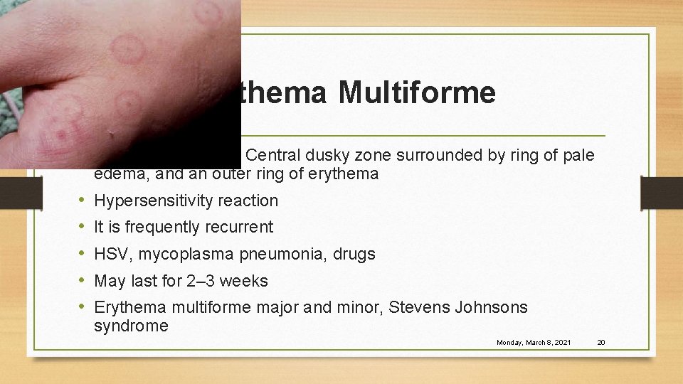 Erythema Multiforme • Target skin lesions. Central dusky zone surrounded by ring of pale