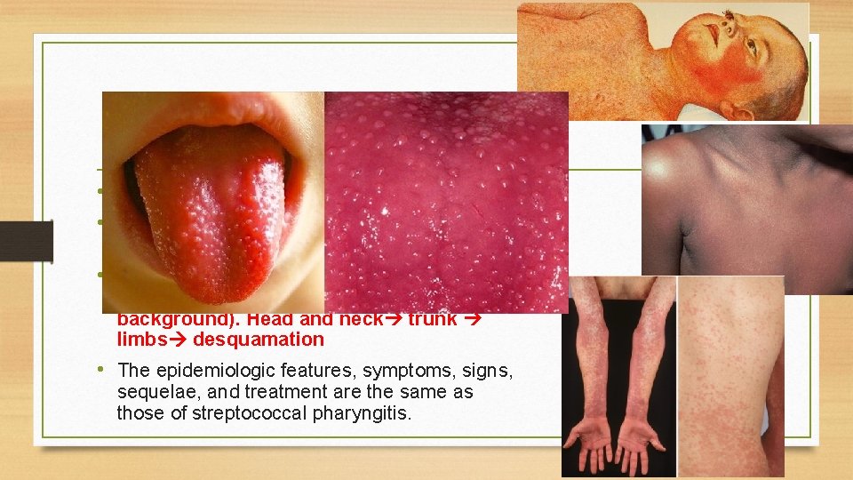 Scarlet fever • Group A strep- erythrogenic exotoxins • Often with pharyngitis and rarely