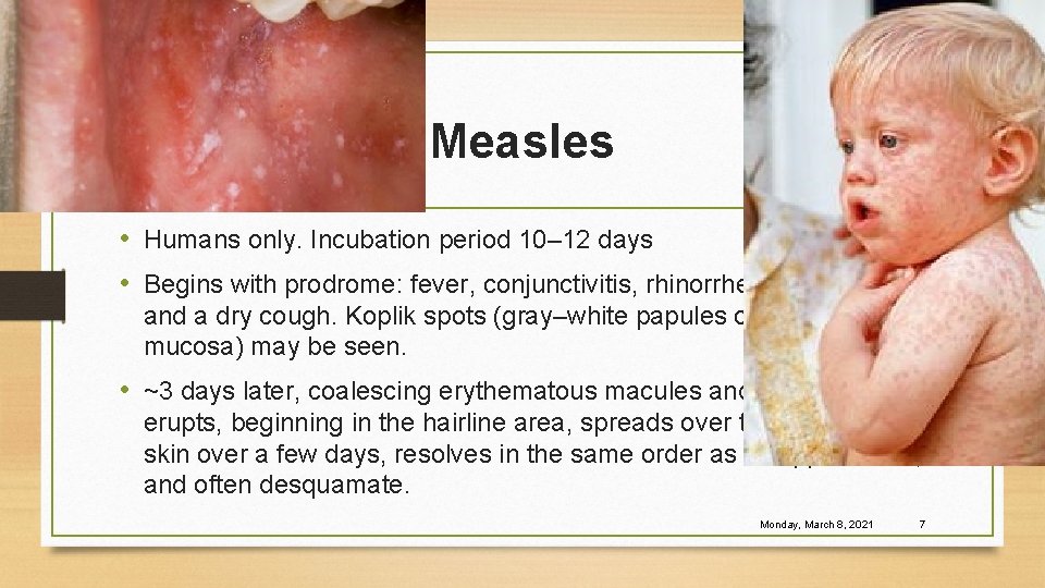 Measles • Humans only. Incubation period 10– 12 days • Begins with prodrome: fever,