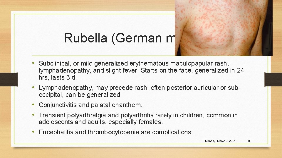 Rubella (German measles) • Subclinical, or mild generalized erythematous maculopapular rash, lymphadenopathy, and slight