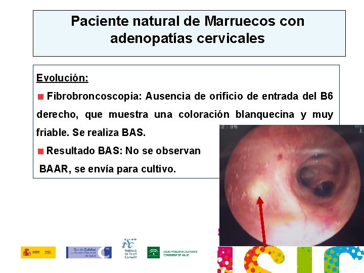 Paciente natural de Marruecos con adenopatías cervicales Evolución: Fibrobroncoscopia: Ausencia de orificio de entrada