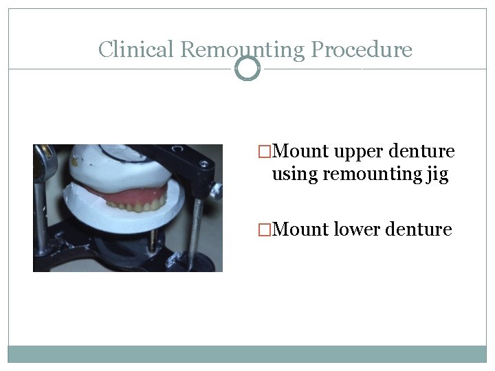 Clinical Remounting Procedure �Mount upper denture using remounting jig �Mount lower denture 