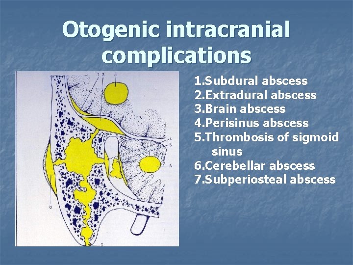 Otogenic intracranial complications 1. Subdural abscess 2. Extradural abscess 3. Brain abscess 4. Perisinus