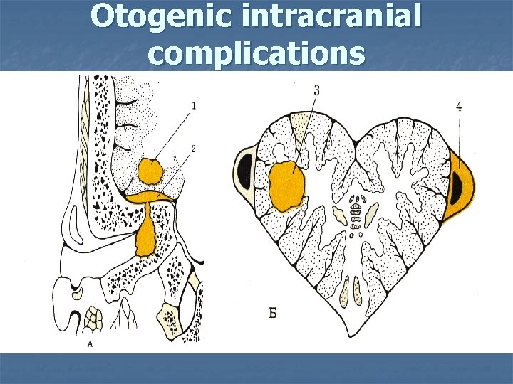 Otogenic intracranial complications 
