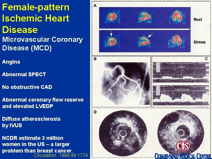 Female-pattern Ischemic Heart Disease Microvascular Coronary Disease (MCD) Angina Abnormal SPECT No obstructive CAD