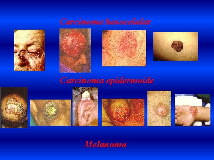 Carcinoma basocelular Carcinoma epidermoide Melanoma 
