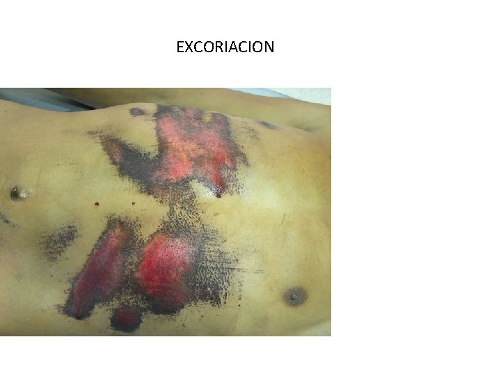 EXCORIACION 