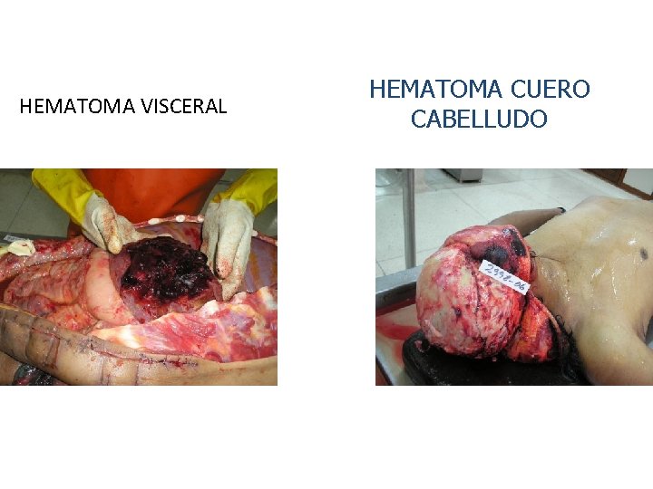 HEMATOMA VISCERAL HEMATOMA CUERO CABELLUDO 