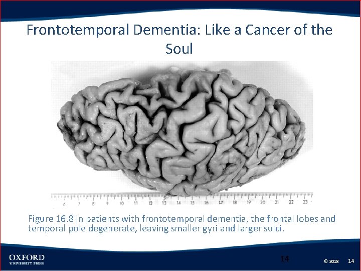 Frontotemporal Dementia: Like a Cancer of the Soul Figure 16. 8 In patients with