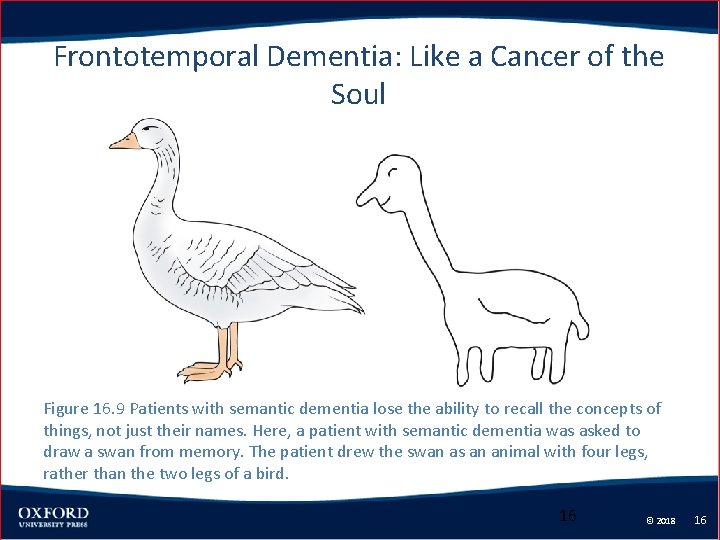 Frontotemporal Dementia: Like a Cancer of the Soul Figure 16. 9 Patients with semantic