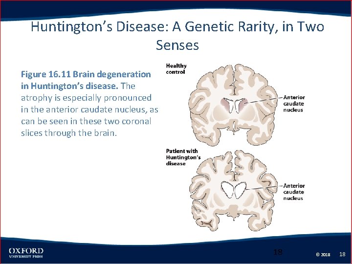 Huntington’s Disease: A Genetic Rarity, in Two Senses Figure 16. 11 Brain degeneration in