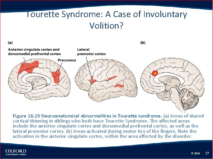 Tourette Syndrome: A Case of Involuntary Volition? Figure 16. 15 Neuroanatomical abnormalities in Tourette