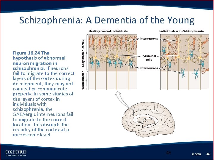 Schizophrenia: A Dementia of the Young Figure 16. 24 The hypothesis of abnormal neuron
