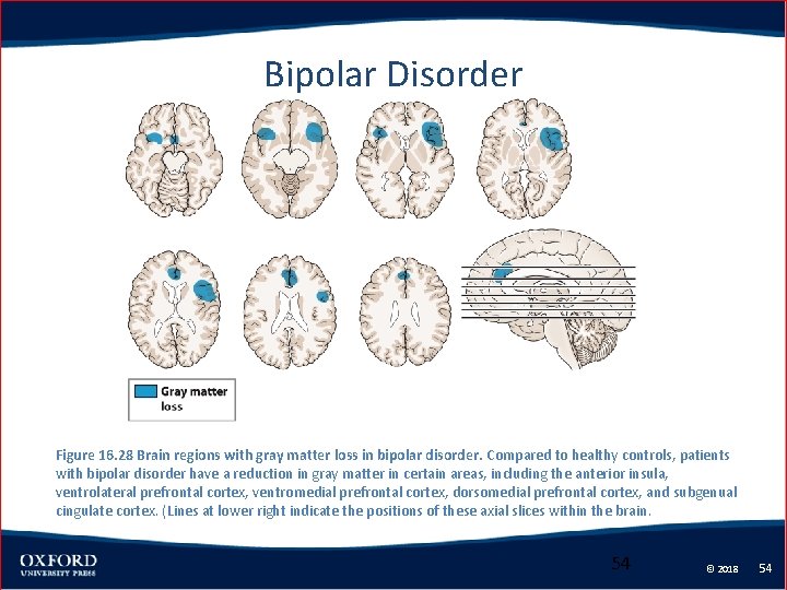 Bipolar Disorder Figure 16. 28 Brain regions with gray matter loss in bipolar disorder.