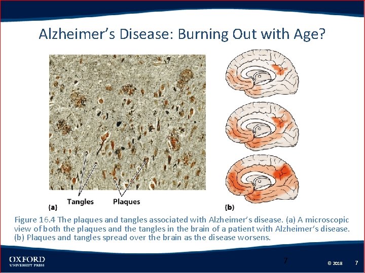 Alzheimer’s Disease: Burning Out with Age? Figure 16. 4 The plaques and tangles associated