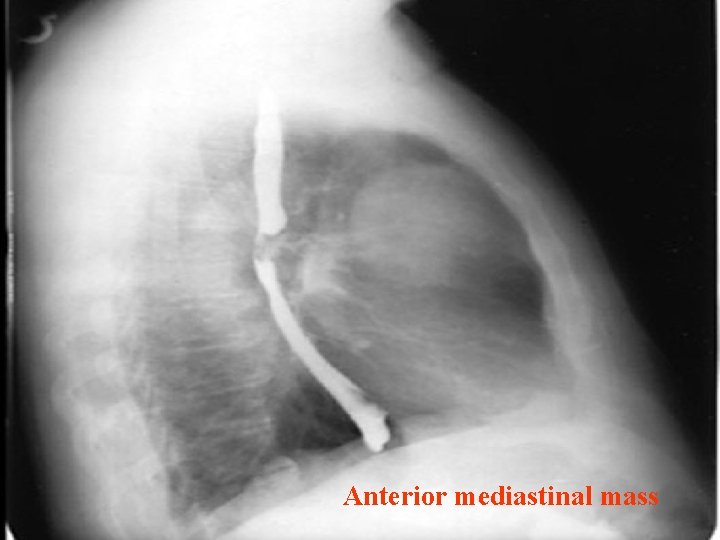 Anterior mediastinal mass 