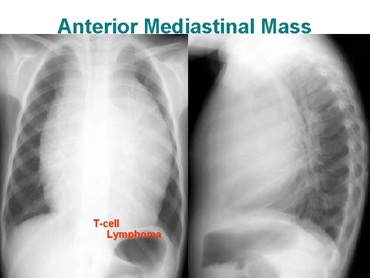 Anterior Mediastinal Mass T-cell Lymphoma 