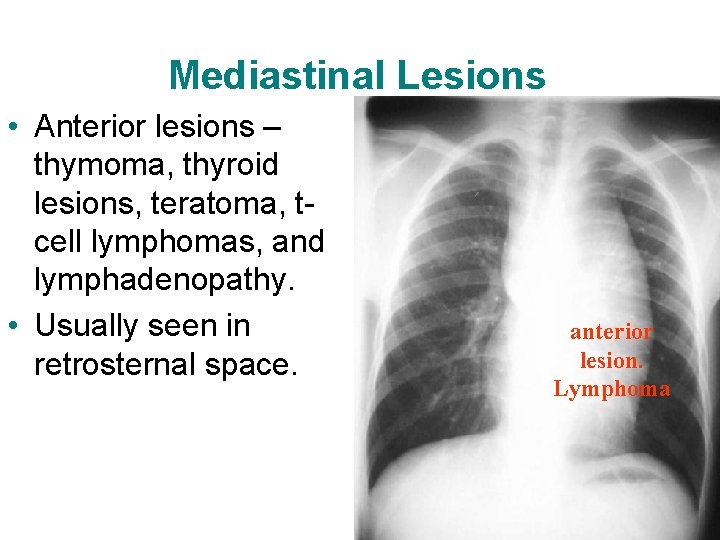 Mediastinal Lesions • Anterior lesions – thymoma, thyroid lesions, teratoma, tcell lymphomas, and lymphadenopathy.