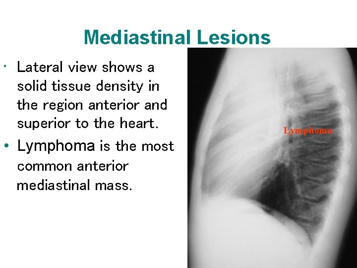 Mediastinal Lesions • Lateral view shows a solid tissue density in the region anterior