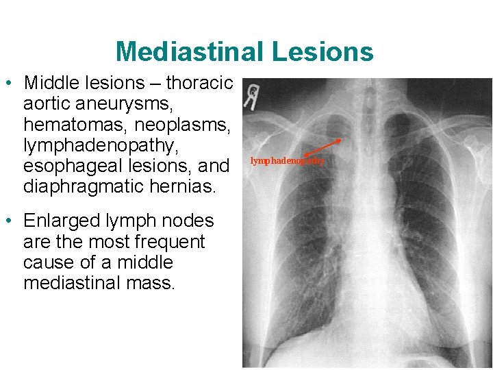 Mediastinal Lesions • Middle lesions – thoracic aortic aneurysms, hematomas, neoplasms, lymphadenopathy, esophageal lesions,