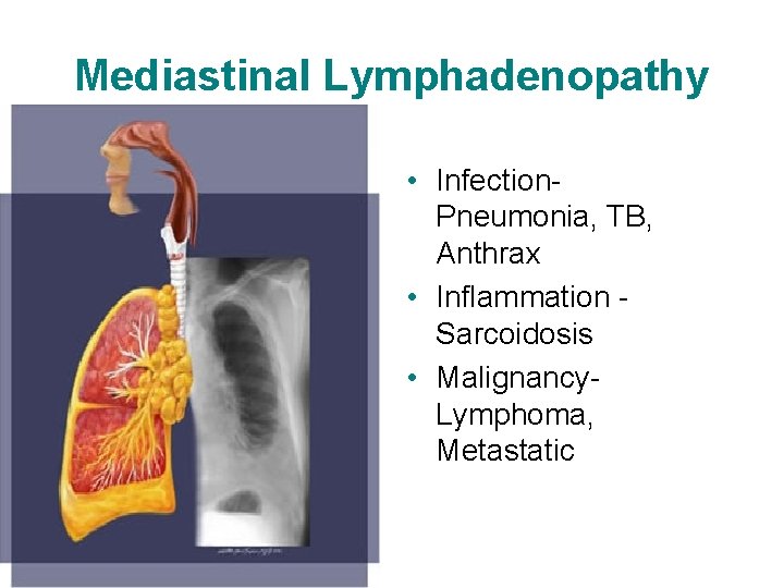 Mediastinal Lymphadenopathy • Infection. Pneumonia, TB, Anthrax • Inflammation Sarcoidosis • Malignancy. Lymphoma, Metastatic