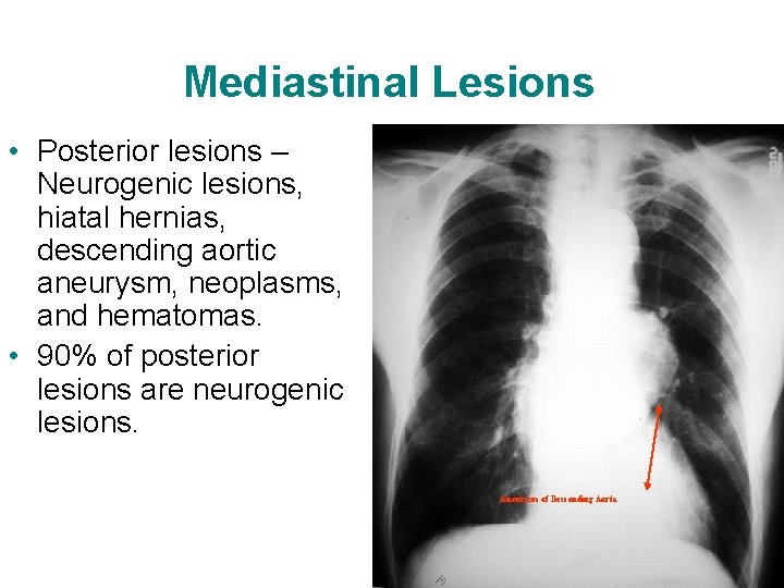 Mediastinal Lesions • Posterior lesions – Neurogenic lesions, hiatal hernias, descending aortic aneurysm, neoplasms,