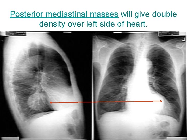 Posterior mediastinal masses will give double density over left side of heart. 